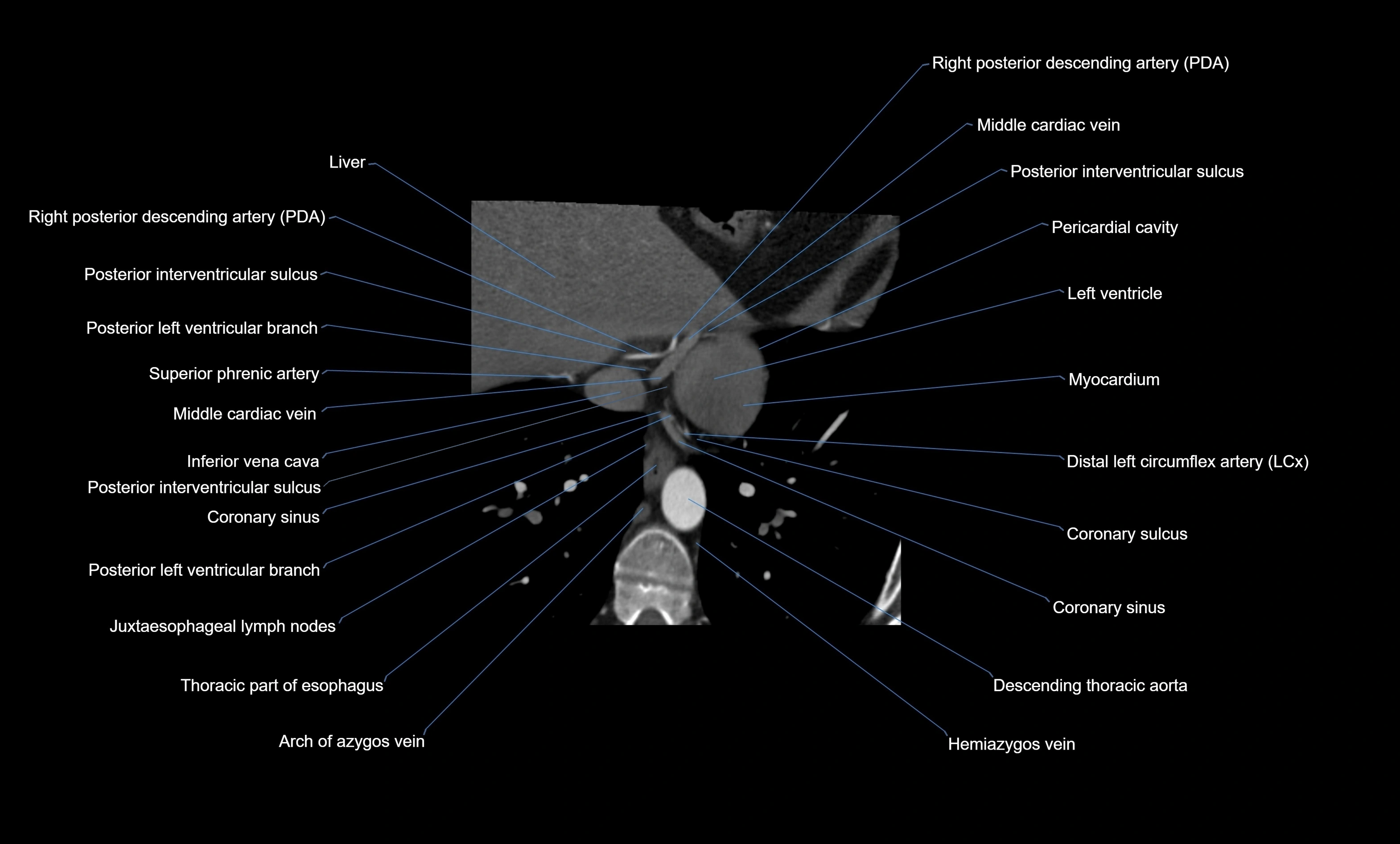 CT heart (coronary angiogram) four chamber view  cross sectional anatomy labelled radiology image -00040.webp